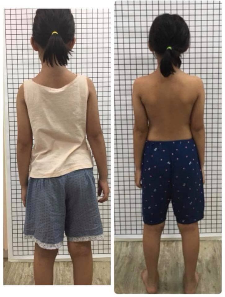 scoliosis-overview Facebook 原始貼文照片 1
