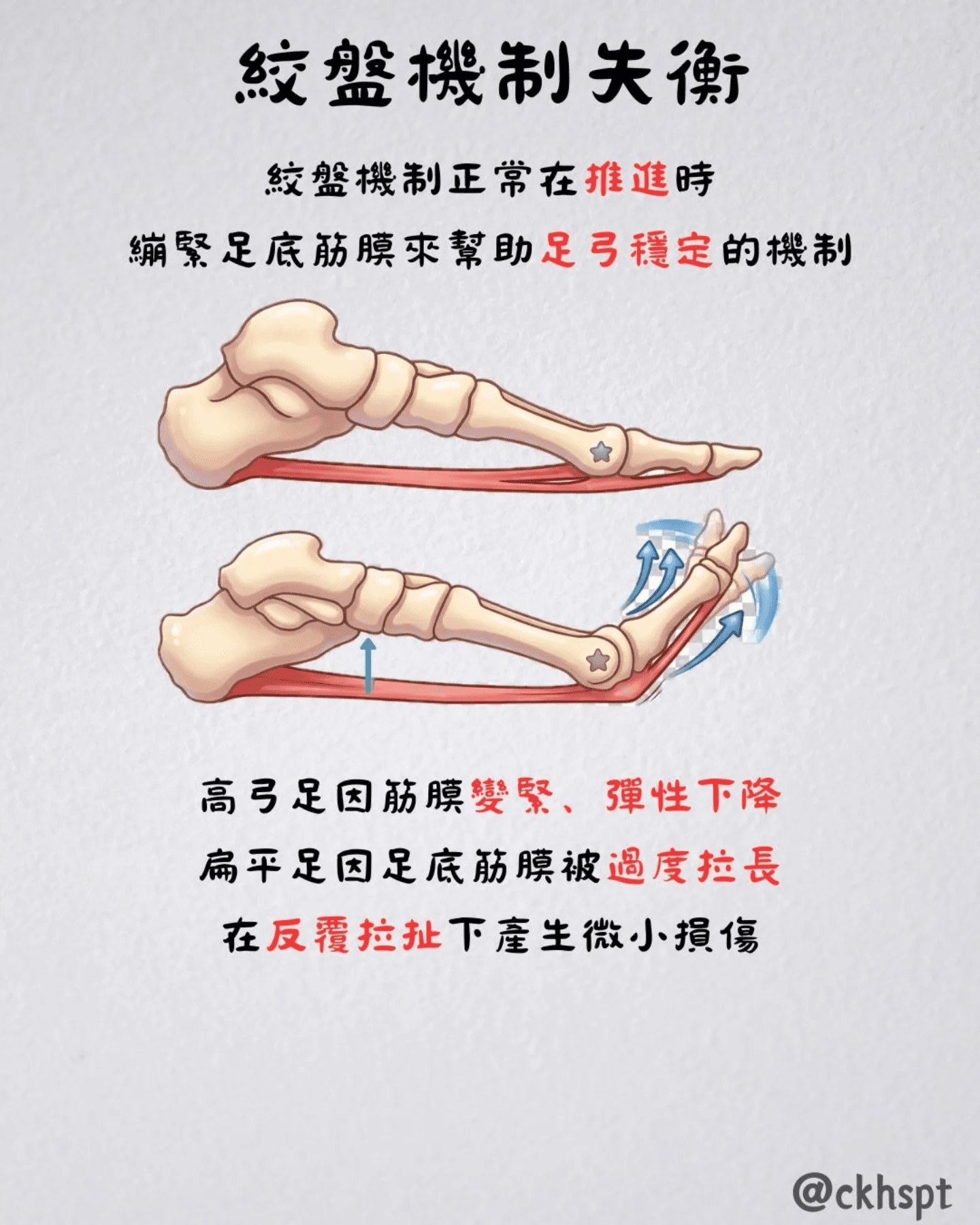 足底筋膜炎原始 Facebook 圖文 5